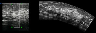 iPano Breast panorama
