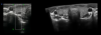 iPano Thyroid panorama