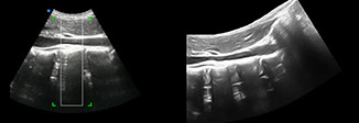 iPano Liver and IVC panorama