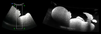 iPano fetal phantom